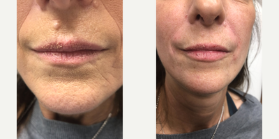 Lip Fillers before and after photo