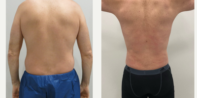 Vaser Liposuction before and after photo
