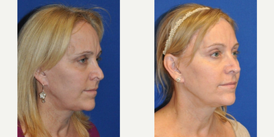 Brow Lift before and after photo