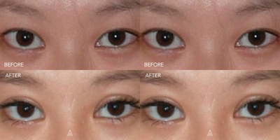 Eyelid Surgery before and after photo