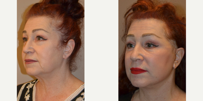 SMAS Facelift before and after photo
