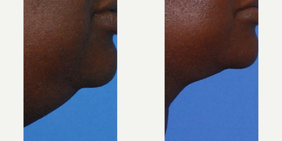 Chin Liposuction before and after photo