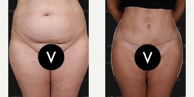 Liposuction before and after photo