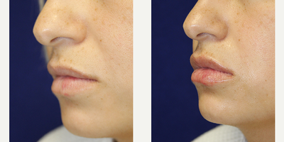 Vollure before and after photo