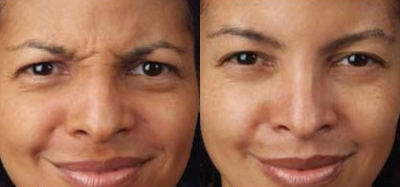 Botox before and after photo