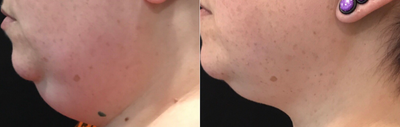 CoolSculpting before and after photo