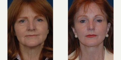 Dermal Fillers before and after photo
