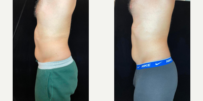 Emsculpt before and after photo
