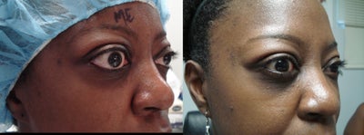 Eyelid Retraction Repair before and after photo