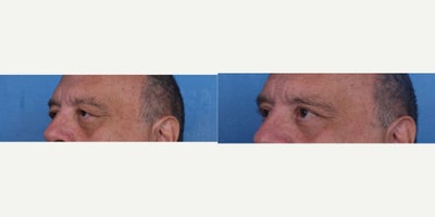 Eyelid Surgery before and after photo