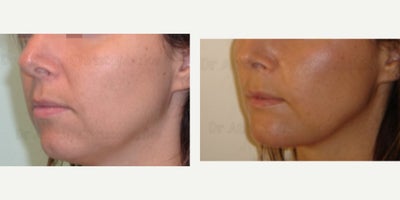 Genioplasty before and after photo