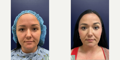 Liposuction before and after photo