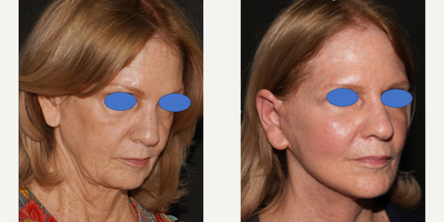 Neck Lift before and after photo