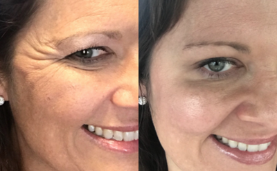 Botox before and after photo