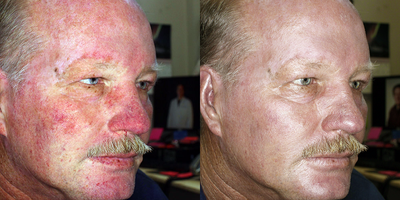 IPL before and after photo