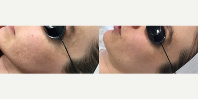 IPL before and after photo