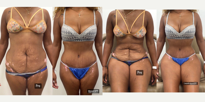 Liposuction before and after photo