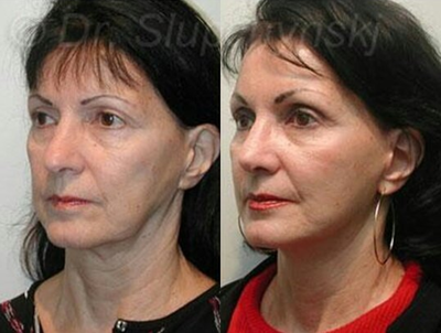 Brow Lift before and after photo
