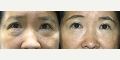 Double Eyelid Surgery before and after photo