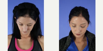 Rhinoplasty before and after photo