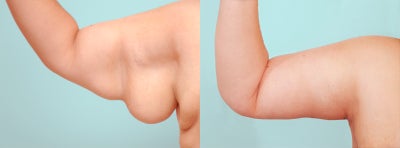 Arm Lift before and after photo