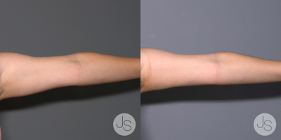 Arm Lift before and after photo