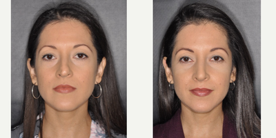 Eyelid Surgery before and after photo