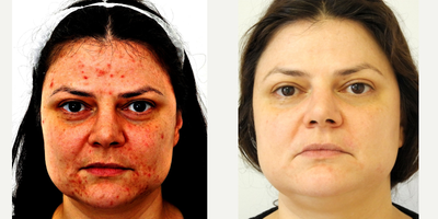 Laser Resurfacing before and after photo