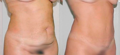 Tummy Tuck before and after photo