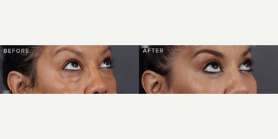Eyelid Surgery before and after photo