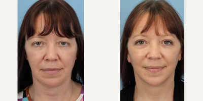 Facelift before and after photo