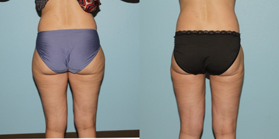 Liposuction before and after photo