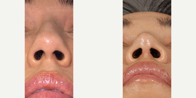 Rhinoplasty before and after photo