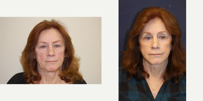 Facelift before and after photo