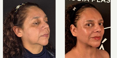 Facelift before and after photo