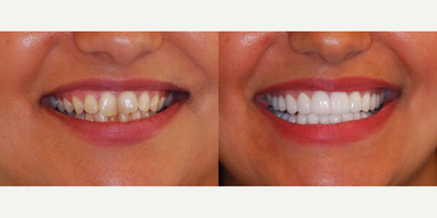 Dental Crown before and after photo