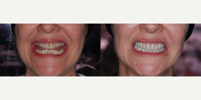 Dental Implants before and after photo