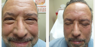Eyelid Surgery before and after photo