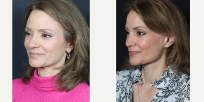 Facelift before and after photo