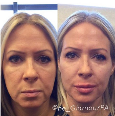 Juvederm before and after photo