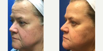 Restylane Silk before and after photo