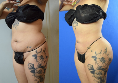 Smart Lipo before and after photo