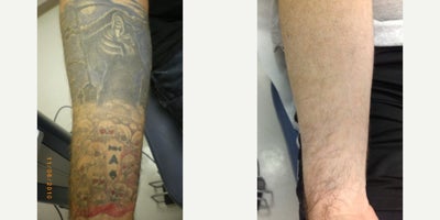 Tattoo Removal before and after photo