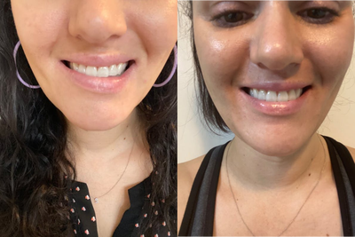 Botox before and after photo
