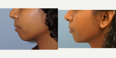Cheek Augmentation before and after photo
