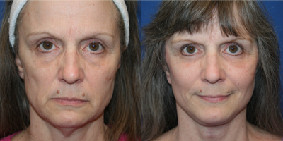 Deep Plane Facelift before and after photo