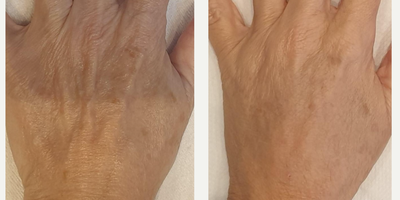 Dermal Fillers before and after photo