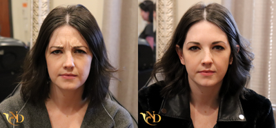 Dysport before and after photo