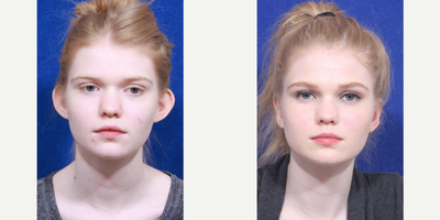Ear Surgery before and after photo