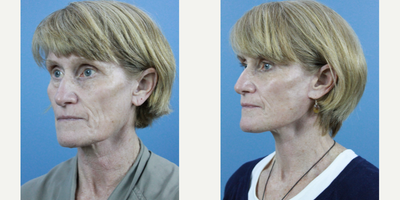Facial Fat Transfer before and after photo